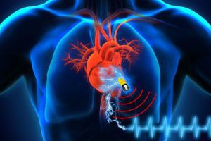 supercapacitor pacemaker device pacemakers