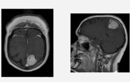 Bill Betten MRI brain tumor medtech expert product development DeviceTalks Minnesoate