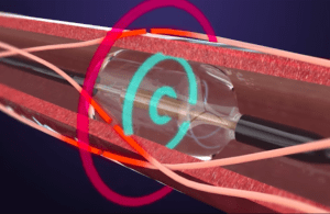 An illustration showing how ReCor Medical's ultrasound renal denervation catheter works inside a patient's artery.