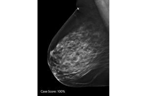 iCAD 3D mammography AI