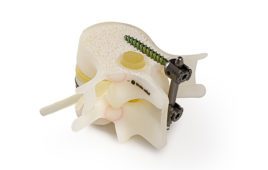 A Stratasys 3d printed anatomical model of spinal pedicel screw insertion