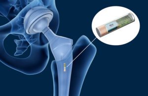 A hip implant powered by an Ilika battery