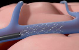 Synchron's Stentrode device expands inside a blood vessel on the brain to relay motor signals