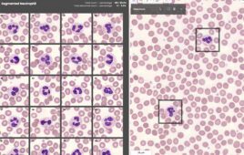 A screenshot showing blood samples enlarged with a microscope and annotated with AI