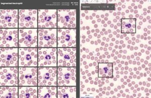 A screenshot showing blood samples enlarged with a microscope and annotated with AI