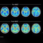 A series of before-and-after brain scans showing improvement in long COVID patients after hyperbaric oxygen therapy