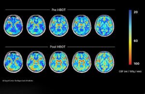 一系列前后的大脑扫描显示长COVID患者高压氧治疗后的改善