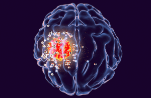 Stanford Medicine brain implant