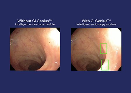 Marketing image shows a colonoscopy image with and without the GI Genius distributed by Medtronic that leverages AI