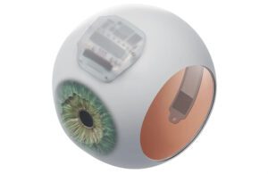 An illustration showing an visual display implanted inside a human eye.