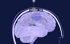 Northwestern Medicine skull-implantable ultrasound for chemotherapy delivery