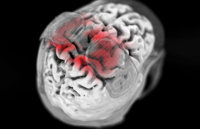 An illustration showing brain implants monitoring motor cortex activity.