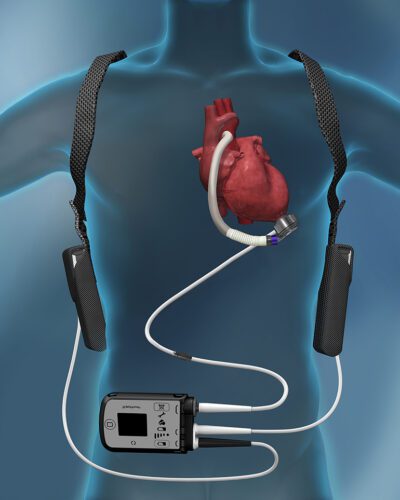 An Abbott marketing illustration shows an implanted HeartMate 3 LVAD with its external equipment.