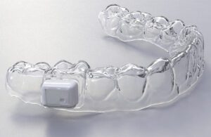 A rendering of Lura Health's tiny saliva sensor in a removable retainer.